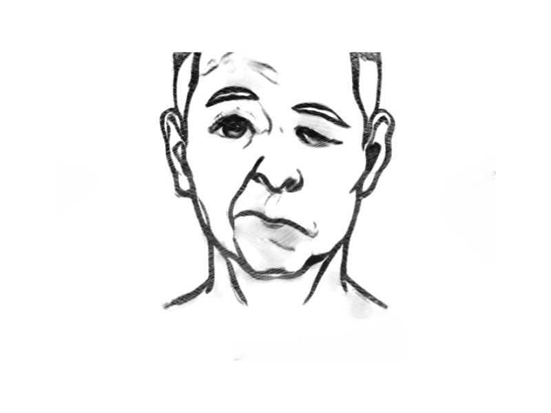 顔面神経麻痺のイラスト